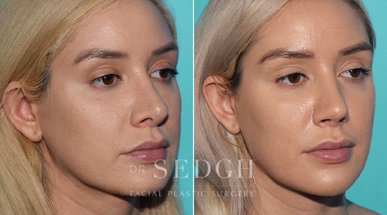 Revision Rhinoplasty Before and After | Sedgh