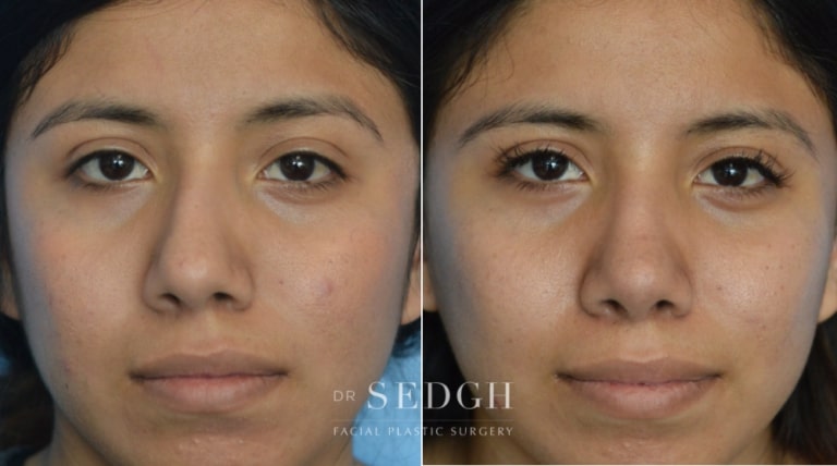 Rhinoplasty Before and After | Sedgh