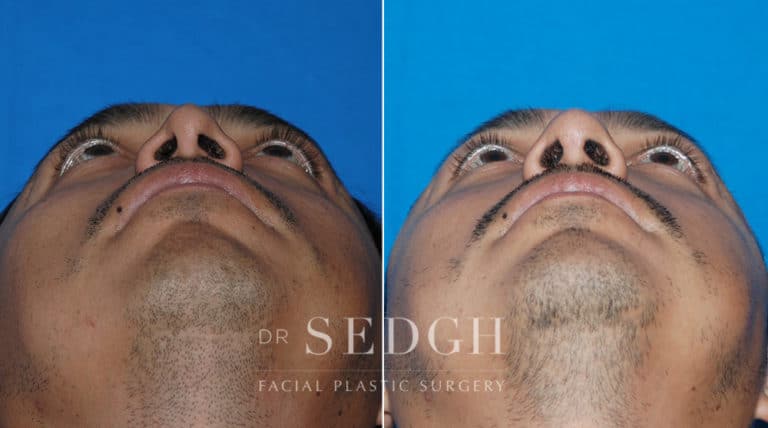 Revision Rhinoplasty Before and After | Sedgh