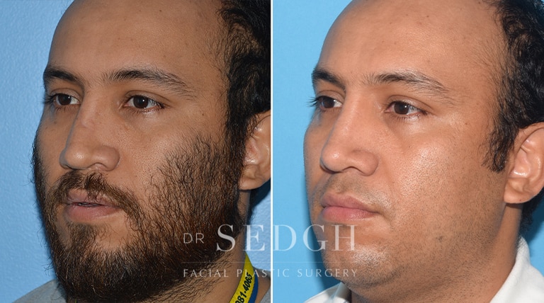 Rhinoplasty Before and After | Sedgh