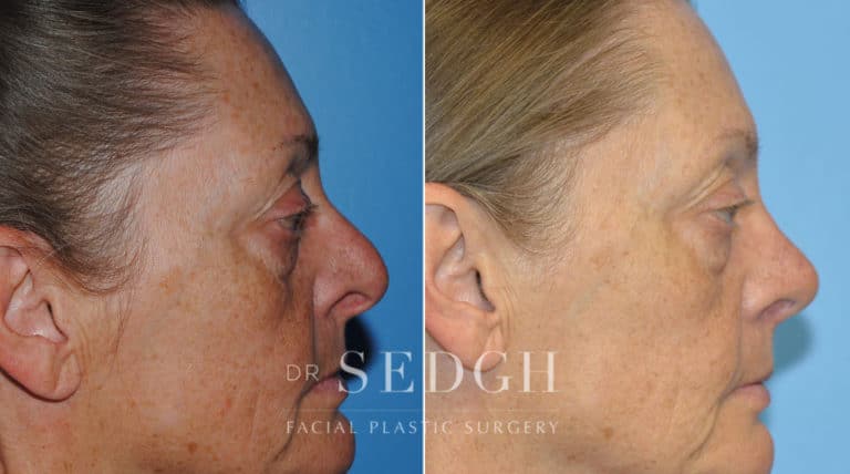 Revision Rhinoplasty Before and After | Sedgh