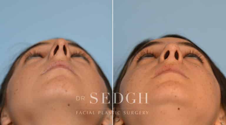 Rhinoplasty Before and After | Sedgh