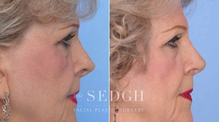 Revision Rhinoplasty Before and After | Sedgh