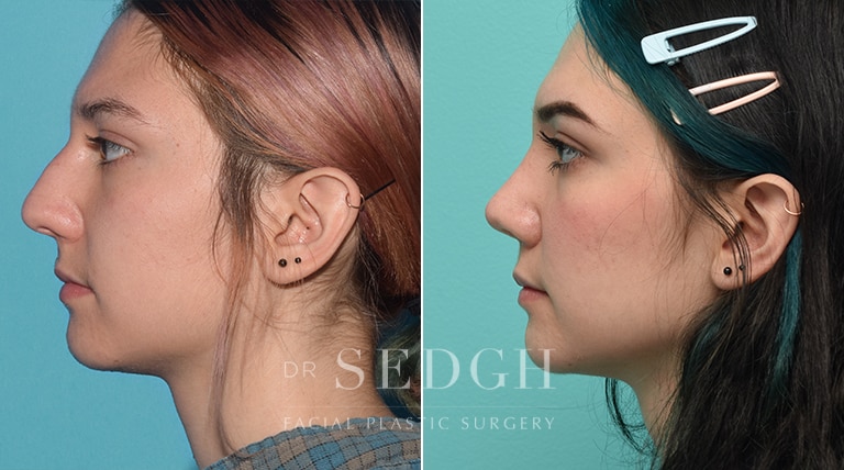 Rhinoplasty Before and After | Sedgh