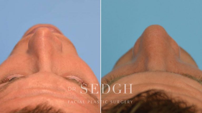 Rhinoplasty Before and After | Sedgh