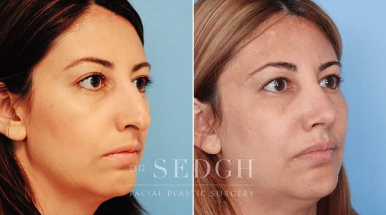 Rhinoplasty Before and After | Sedgh