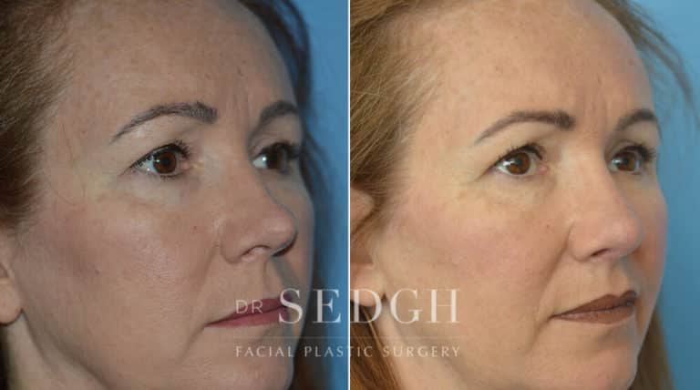 Rhinoplasty Before and After | Sedgh