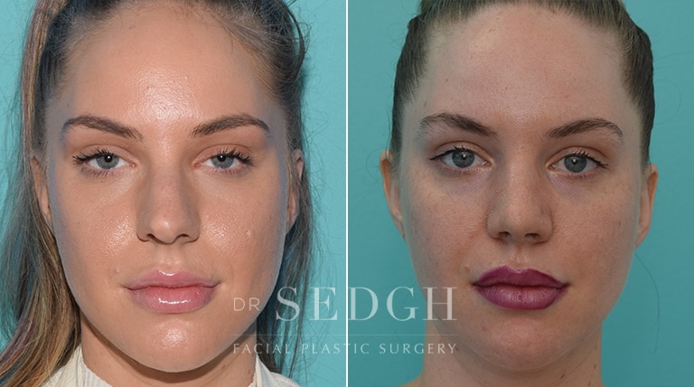 Crooked Nose Surgery Before and After | Sedgh