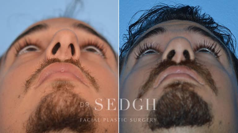 Rhinoplasty Before and After | Sedgh