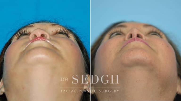 Crooked Nose Surgery Before and After | Sedgh