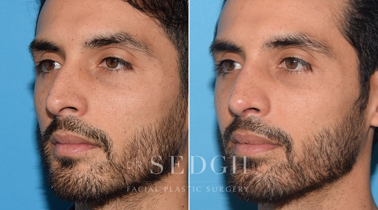 Rhinoplasty Before and After | Sedgh