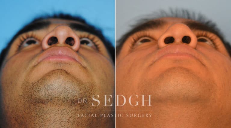 Crooked Nose Surgery Before and After | Sedgh