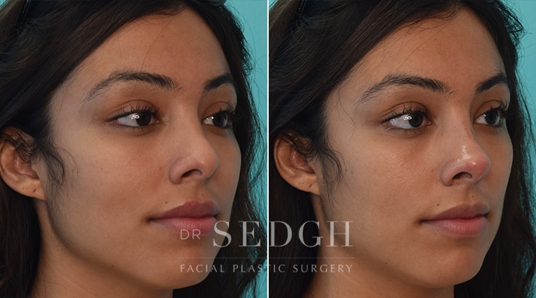 Facial Fillers Before and After | Sedgh