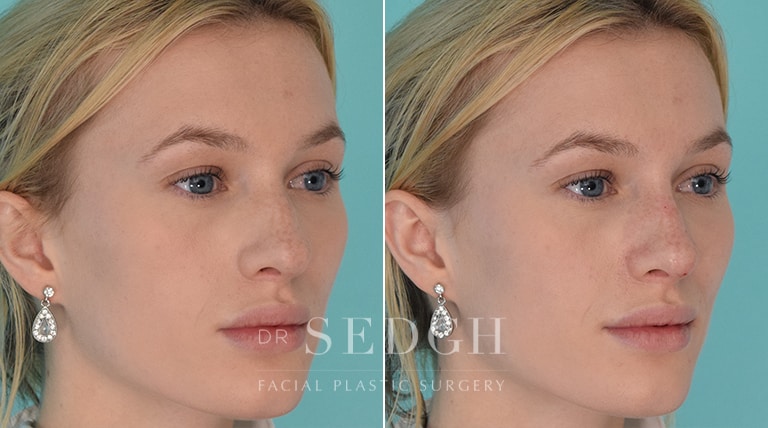 Facial Fillers Before and After | Sedgh