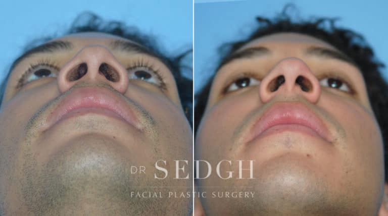 Crooked Nose Surgery Before and After | Sedgh