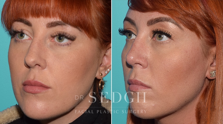 Facial Fillers Before and After | Sedgh