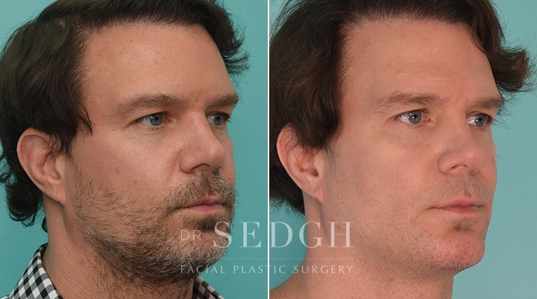 Chin Augmentation Before and After | Sedgh