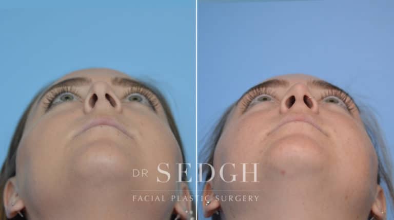 Crooked Nose Surgery Before and After | Sedgh