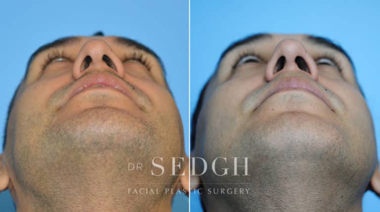 Rhinoplasty Before and After | Sedgh