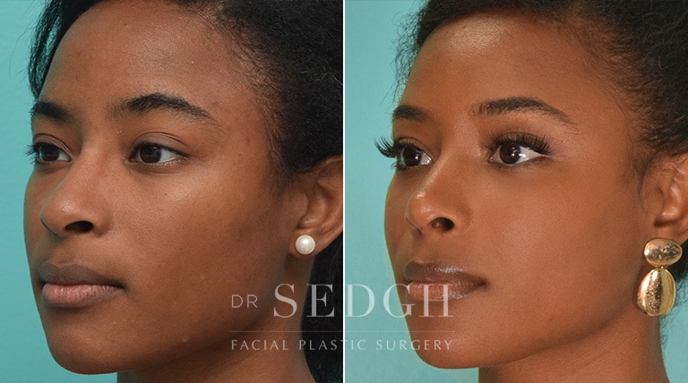 Rhinoplasty Before and After | Sedgh