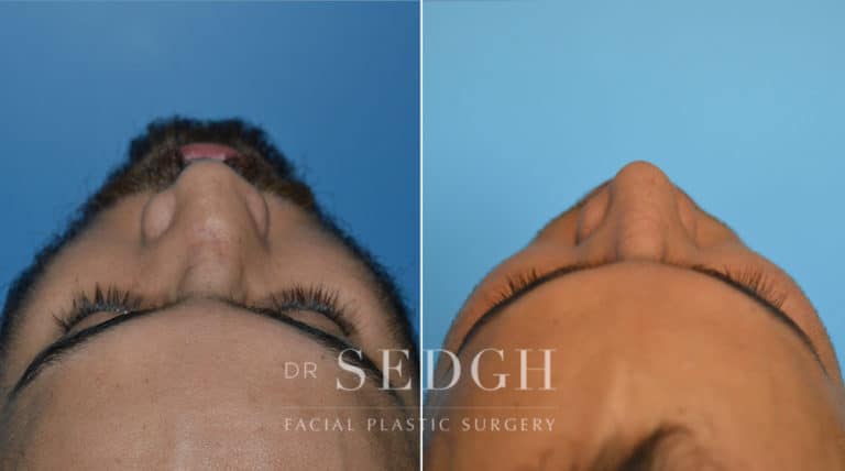 Crooked Nose Surgery Before and After | Sedgh