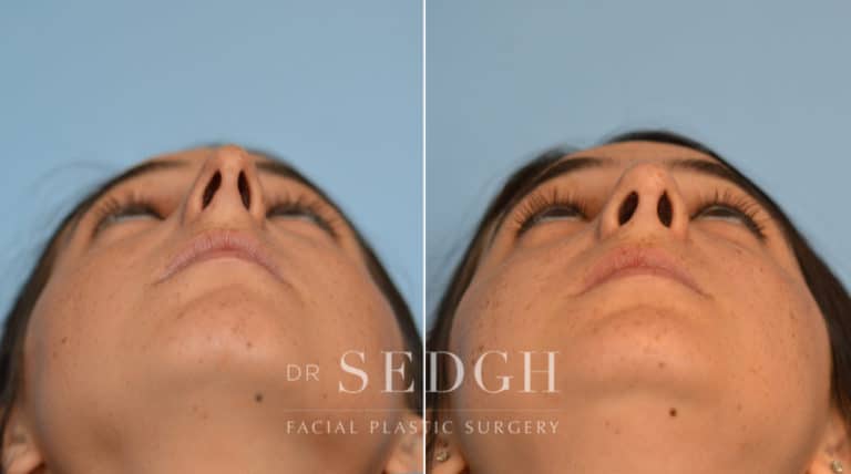 Crooked Nose Surgery Before and After | Sedgh