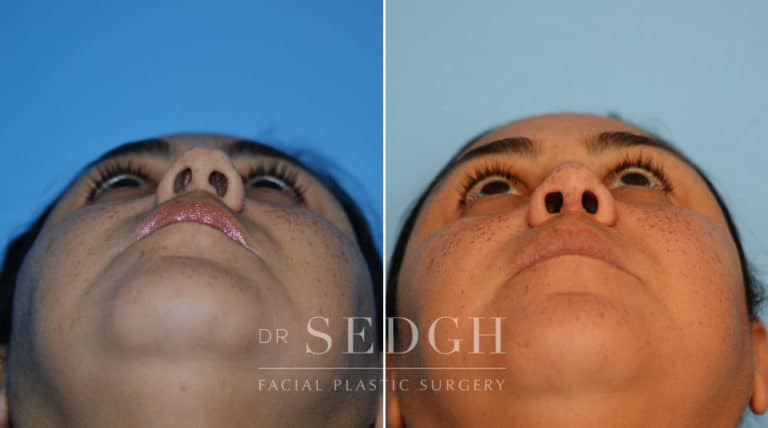 Crooked Nose Surgery Before and After | Sedgh