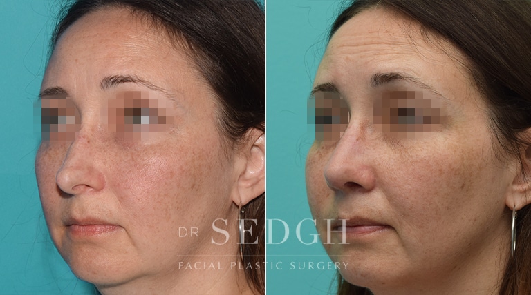 Female Rhinoplasty Before and After | Sedgh