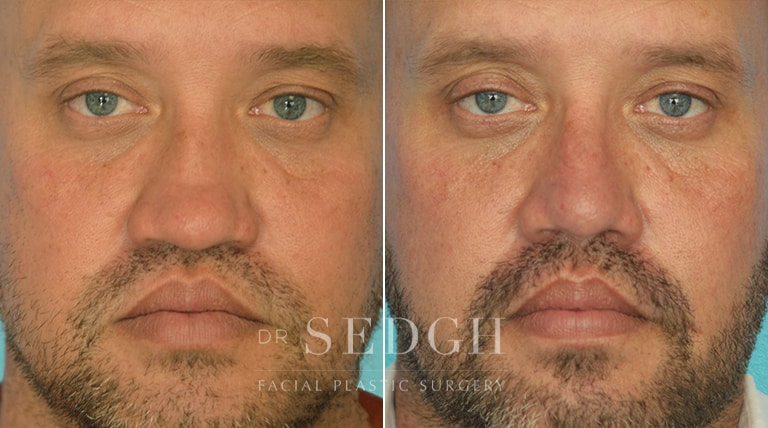 Rhinoplasty Before and After | Sedgh