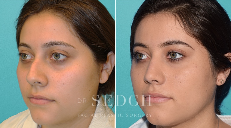 Female Rhinoplasty Before and After | Sedgh