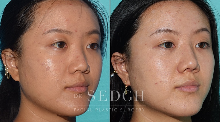 Female Rhinoplasty Before and After | Sedgh