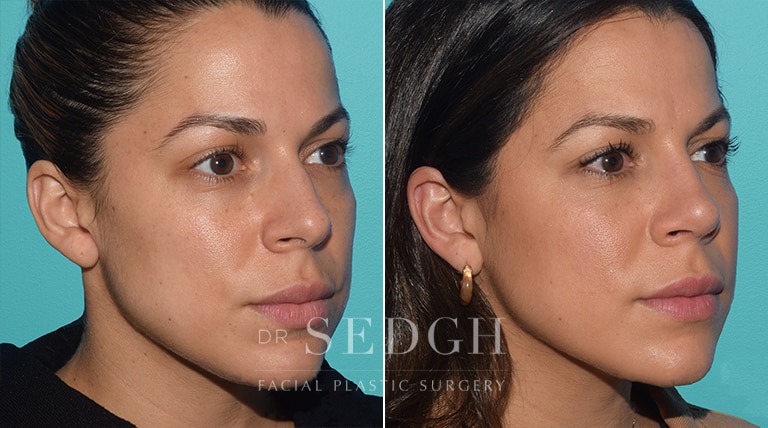 Female Rhinoplasty Before and After | Sedgh