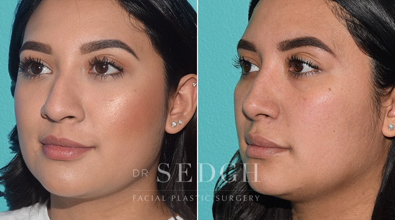 Female Rhinoplasty Before and After | Sedgh