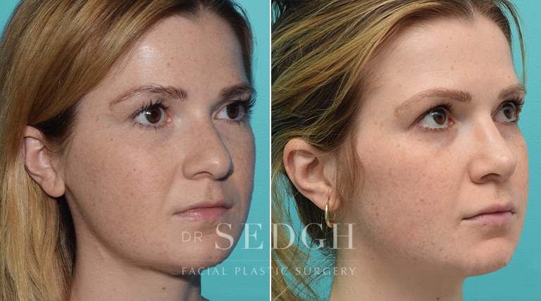 Female Rhinoplasty Before and After | Sedgh