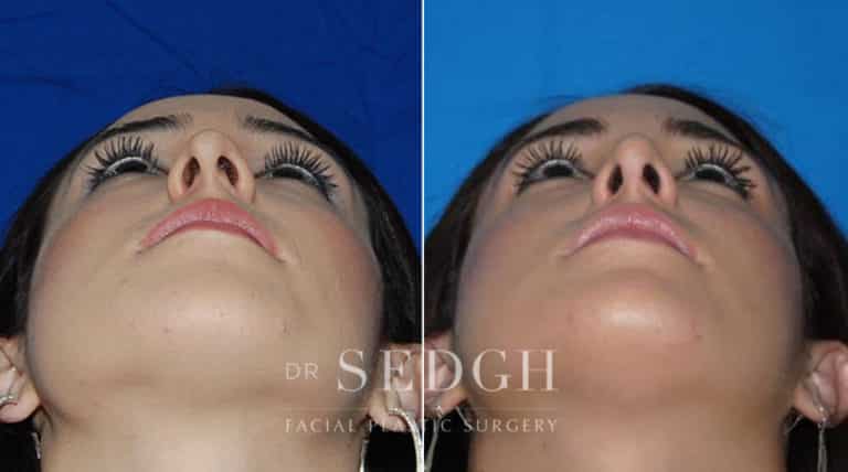 Female Rhinoplasty Before and After | Sedgh