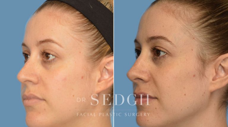 Female Rhinoplasty Before and After | Sedgh