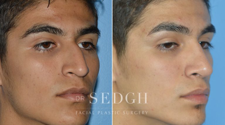 Rhinoplasty Before and After | Sedgh