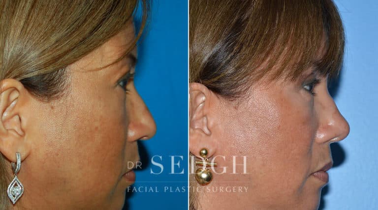 Female Rhinoplasty Before and After | Sedgh