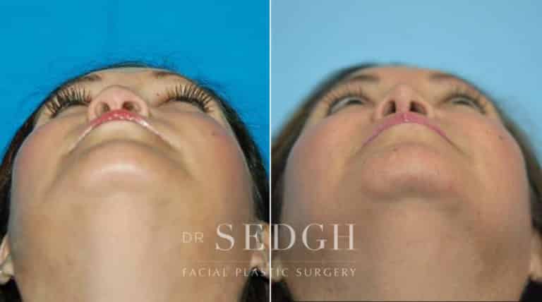 Rhinoplasty Before and After | Sedgh