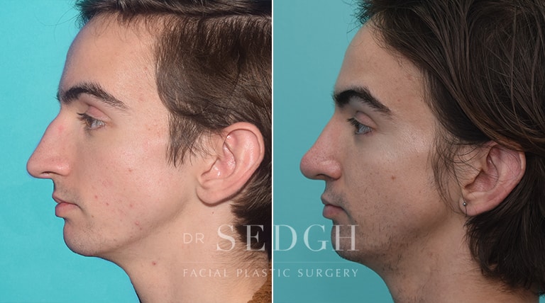 Male Rhinoplasty Before and After | Sedgh