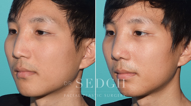 Male Rhinoplasty Before and After | Sedgh