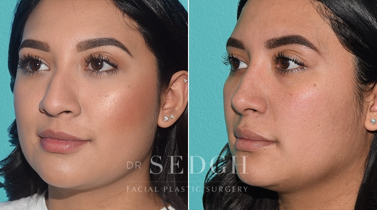 Latino Rhinoplasty Before and After | Sedgh