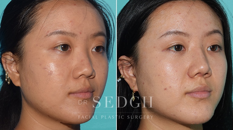 nose job before after asian