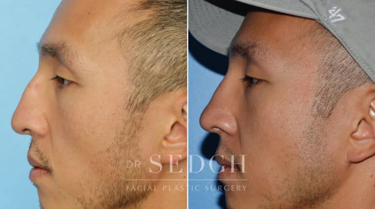 Asian Rhinoplasty Before and After | Sedgh