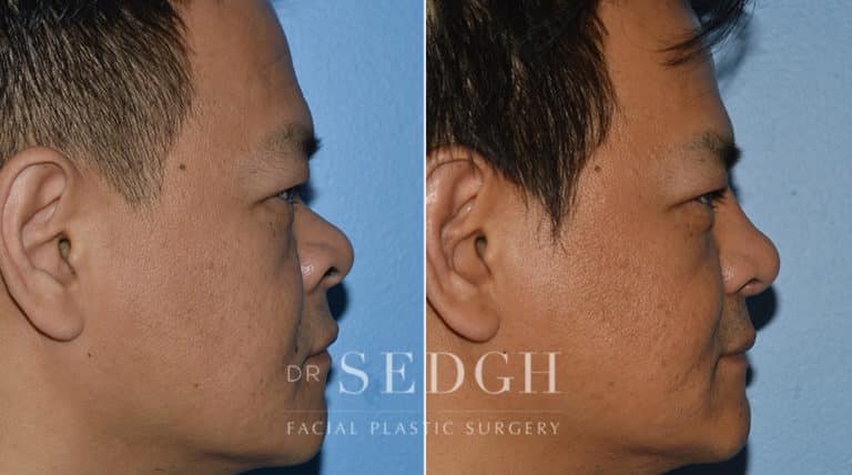 Asian Rhinoplasty Before and After | Sedgh