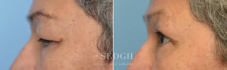 Upper Blepharoplasty Before and After | Sedgh