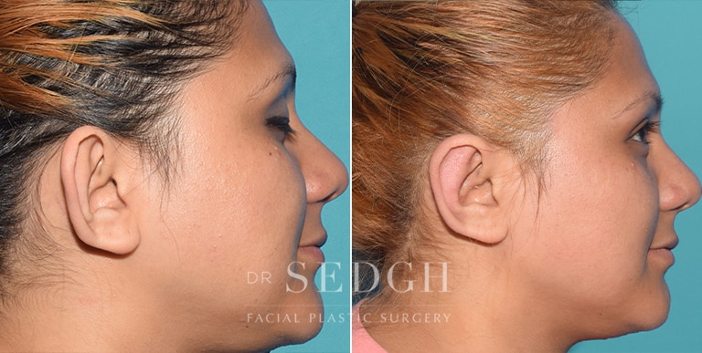 Ear Pinning Surgery Before and After | Sedgh