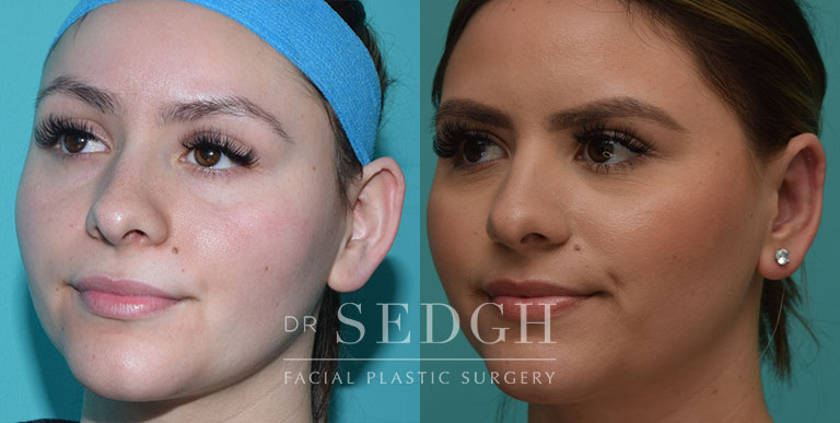 Ear Pinning Surgery Before and After | Sedgh
