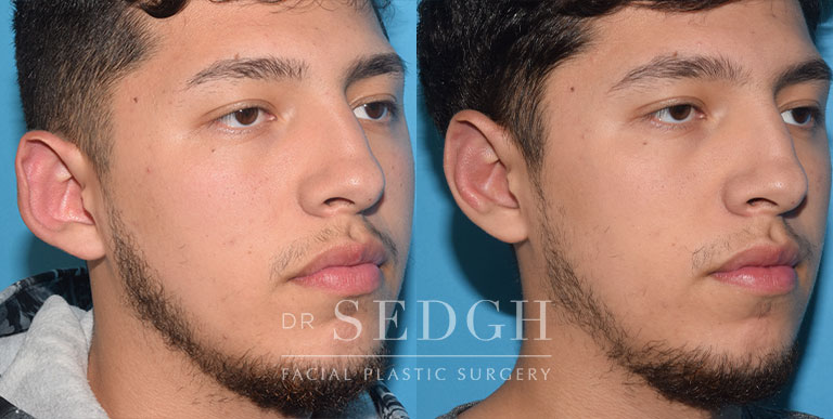 Ear Pinning Surgery Before and After | Sedgh