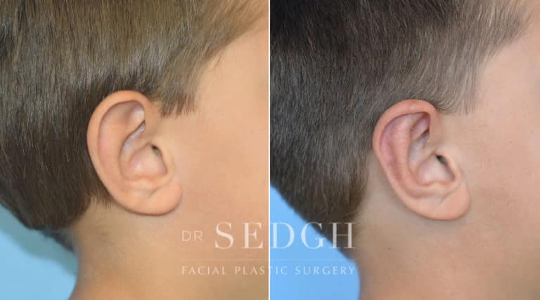 Ear Pinning Surgery Before and After | Sedgh